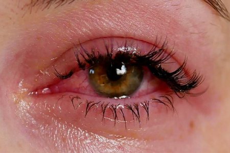 Lash Extension Allergies: The Medical-Grade Safety Guide