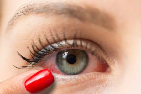 The Ultimate Guide to Allergic Reactions from Lash Extensions: Diagnosis, Treatment & Prevention
